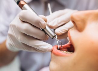 caries-interdentales