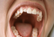 Torus mandibulares y maxilares y su relevancia en la cavidad oral