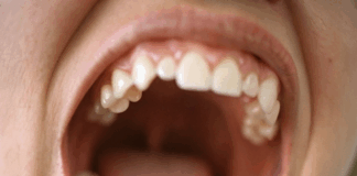 Torus mandibulares y maxilares y su relevancia en la cavidad oral