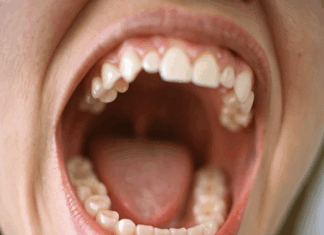 Torus mandibulares y maxilares y su relevancia en la cavidad oral