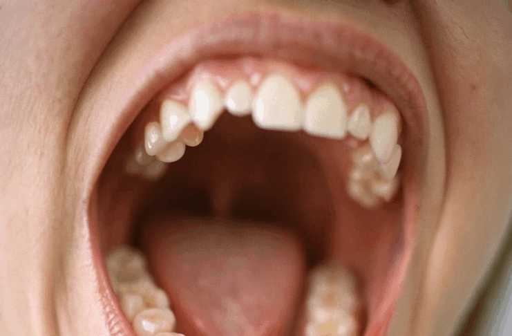 Torus mandibulares y maxilares y su relevancia en la cavidad oral